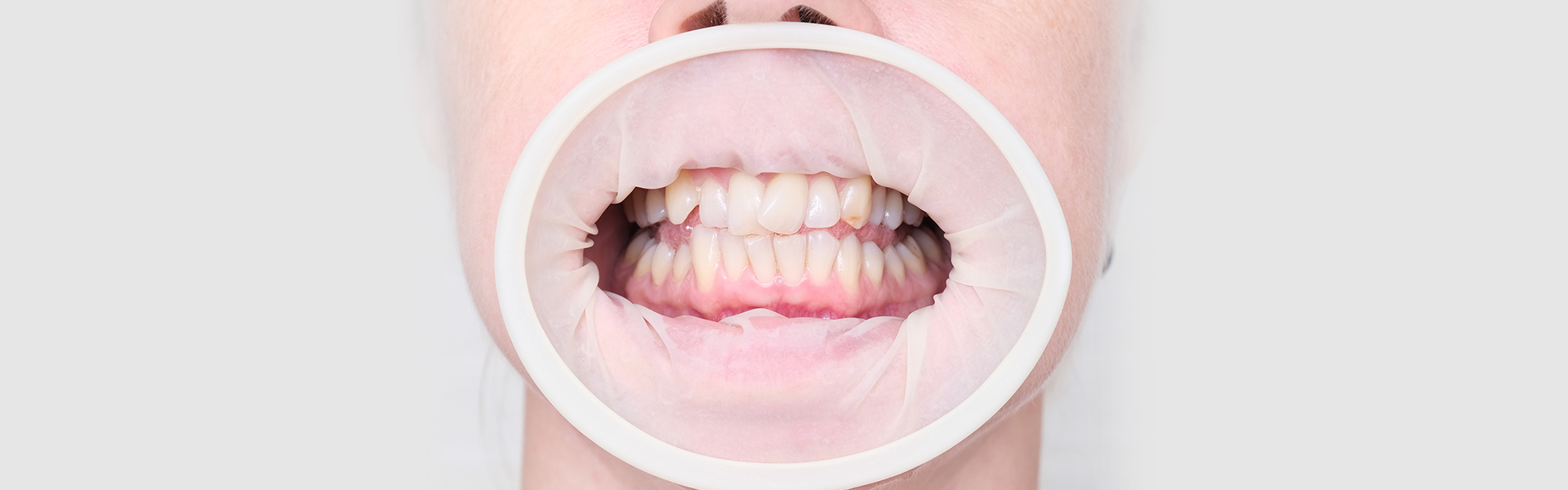 Now Is the Right Time to Get Crooked Teeth Fixed in Illinois Dr. Ahmad Zaidi Distinctive Dental Care