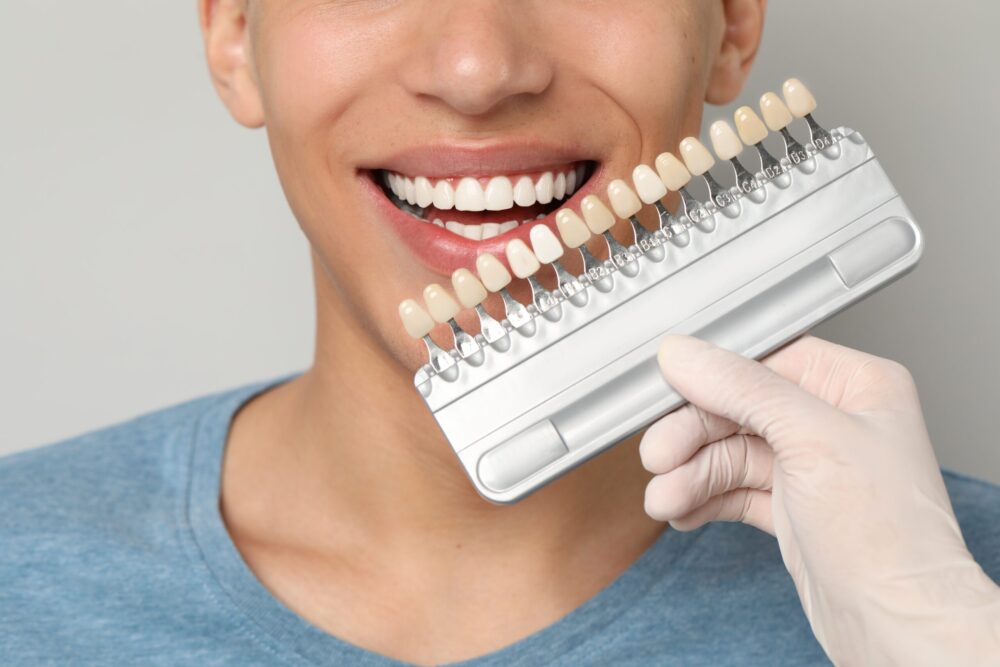 Veneers Oswego